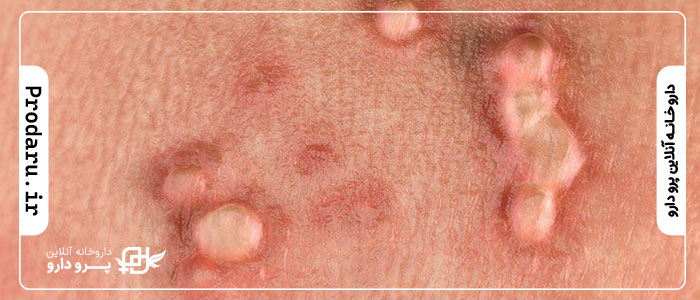 Genital Wart Treatment