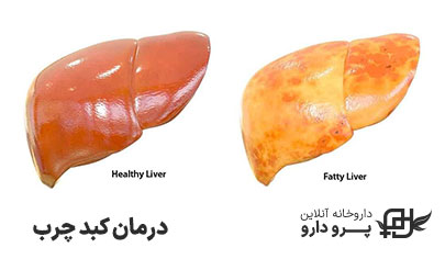 بهترین درمان فوری کبد چرب